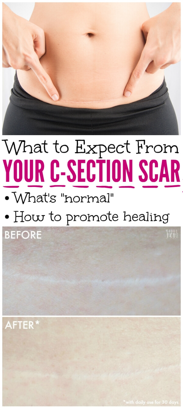 Your CSection Scar 5 Things You Need to Know The Soccer Mom Blog