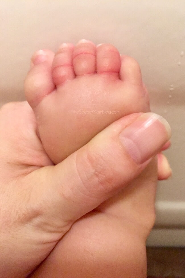 Baby's toes after removing a hair tourniquet