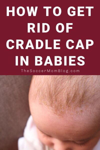 photo of top of a baby's scalp; text overlay "How to Get Rid of Cradle Cap in Babies"